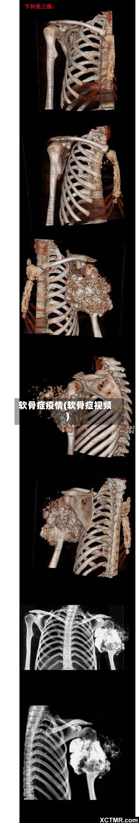 软骨症疫情(软骨症视频)-第2张图片